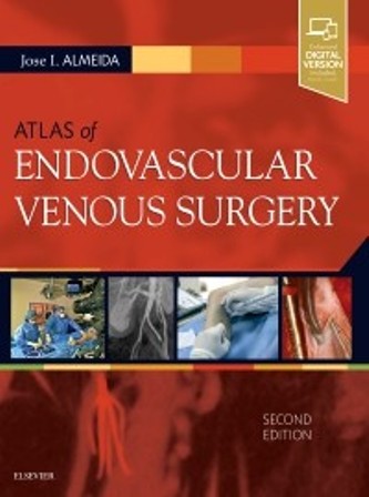 Test Bank for Atlas of Endovascular Venous Surgery 2nd Edition Almeida